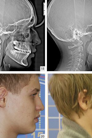 рентгенограмма и фотография до лечения и после лечения
